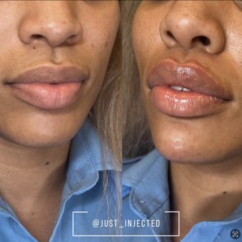 Just Injected - Lip filler before and after. - Medical Spas Near Me - Dallas, Texas Just Injected - Lip filler before and after. - Medical Spas Near Me - Dallas, Texas