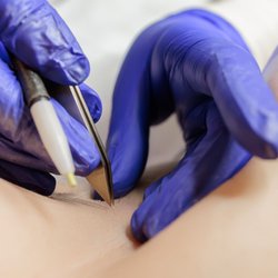 Close-up view of an electrolysis procedure showing precision insertion into a hair follicle using sterile equipment, demonstr...