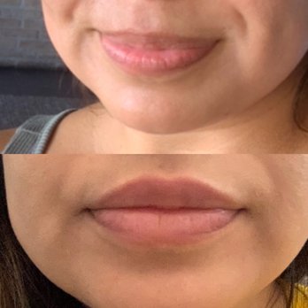 Nurse Katelyn - Before and after. I wanted more of a natural look and to get rid of some lines that were bothering me. Half a syringe of Volbella. - Medical Spas Near Me - San Jose, California Nurse Katelyn - Before and after. I wanted more of a natural look and to get rid of some lines that were bothering me. Half a syringe of Volbella. - Medical Spas Near Me - San Jose, California