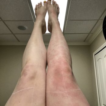 Luma Laser and MedSpa - Laser of legs. - Medical Spas Near Me - Bloomfield Hills, Michigan Luma Laser and MedSpa - Laser of legs. - Medical Spas Near Me - Bloomfield Hills, Michigan