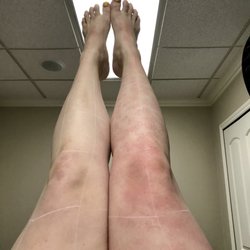 Luma Laser and MedSpa - Laser of legs.