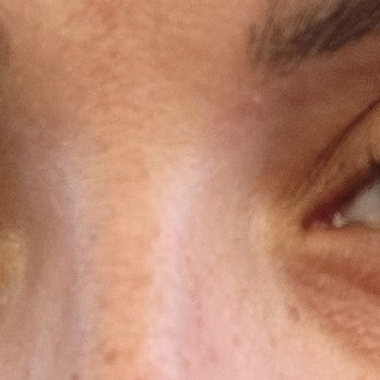 Venus & Mars Aesthetics - After - Skin Care Near Me - Houston Tx, Texas Venus & Mars Aesthetics - After - Skin Care Near Me - Houston Tx, Texas