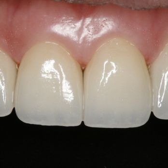 Corporate Pointe Dental - Single tooth porcelain Veneer. Can you guess which is the natural tooth? - General Dentistry Near Me - Culver City, California Corporate Pointe Dental - Single tooth porcelain Veneer. Can you guess which is the natural tooth? - General Dentistry Near Me - Culver City, California