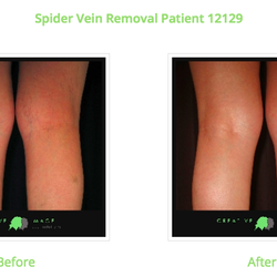 Creative Image Laser Solutions - Spider Vein Removal