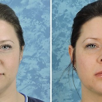 Roberts Cosmetic Surgery - Lip Implant - Skin Care Near Me - Plano, Texas