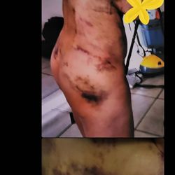 Rozbeh Torabi - Liposuction hematoma seroma stroke nerve damage spine damage I'm on disability
