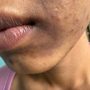 Acne Treatment SF