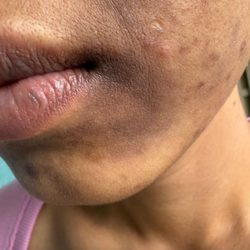 Acne Treatment SF