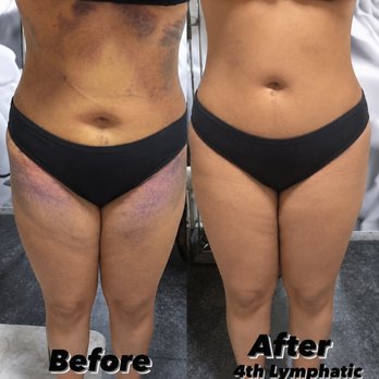 Vida Wellness - Lymphatic Drainage - Body Contouring Near Me - San Diego, California Vida Wellness - Lymphatic Drainage - Body Contouring Near Me - San Diego, California