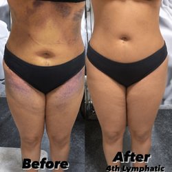 Lymphatic Drainage