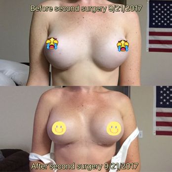 Troy J. Andreasen M.D - Top is 300cc Mentor high profile sub muscular. Bottom is after revision 385cc Naturelle full (high profile) sub muscular - Cosmetic Surgeons Near Me - Bldg #3 Ontario, California Troy J. Andreasen M.D - Top is 300cc Mentor high profile sub muscular. Bottom is after revision 385cc Naturelle full (high profile) sub muscular - Cosmetic Surgeons Near Me - Bldg #3 Ontario, California