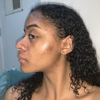 Derm by Erica - Before pic 2 - Skin Care Near Me - Culver City, California