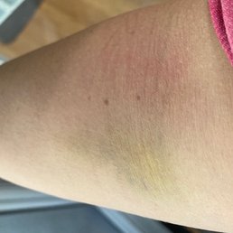 Bruise on my arm after getting blood work here.  And it hurt!  Never again at this place.