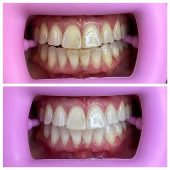 Bora Teeth Whitening - Teeth Whitening Near Me