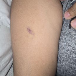 When my therapist pinched my arm .