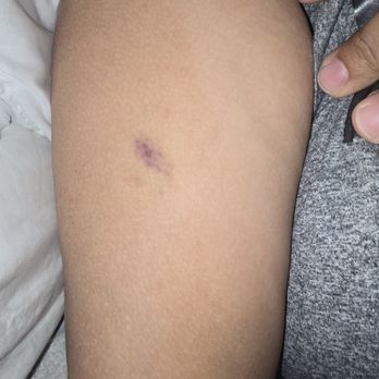 Wildflower Spa - When my therapist pinched my arm . - Skin Care Near Me - Queens, New York