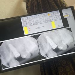 Crown Heights Dental Clinic - The original screw put in.