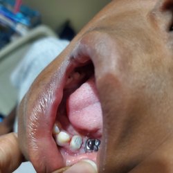 Greenberg Dental & Orthodontics - The latest cap that fell out came from here. Notice his gums are cut as well!