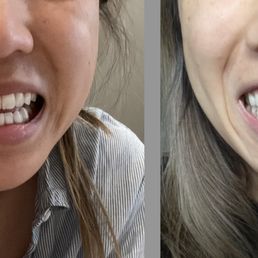 Left (Before) - Jaw dislocation. Right (After) - Teeth are almost back in place Left (Before) - Jaw dislocation. Right (After) - Teeth are almost back in place