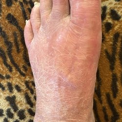 Rogers William DPM Dr - Very swollen and red foot