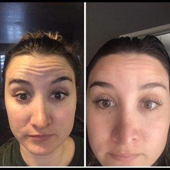 La Bella Laser & Slimming - Before and after Botox (this was pre lip injections so you can also see how thin my lips are ) - Medical Spas Near Me - Arcadia, California La Bella Laser & Slimming - Before and after Botox (this was pre lip injections so you can also see how thin my lips are ) - Medical Spas Near Me - Arcadia, California