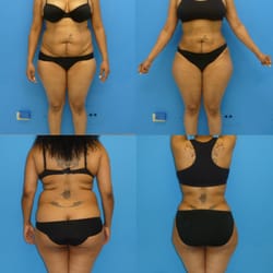 Before Liposuction of the entire midsection  Results After : Sexy Curves