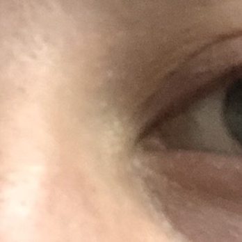 SharpeVision MODERN LASIK & LENS - Uneven pupils from ICL procedure - Laser Eye Surgery/Lasik Near Me - Bellevue, Washington SharpeVision MODERN LASIK & LENS - Uneven pupils from ICL procedure - Laser Eye Surgery/Lasik Near Me - Bellevue, Washington