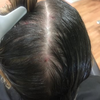 Professional Removal Of Lice In Nits Estimated Removal Time 1