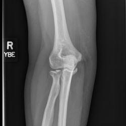 Wai Kuen Wong Herbalist Consulting Center - got acute radial head fracture with 2 mm cortical articular surface impaction from work in July