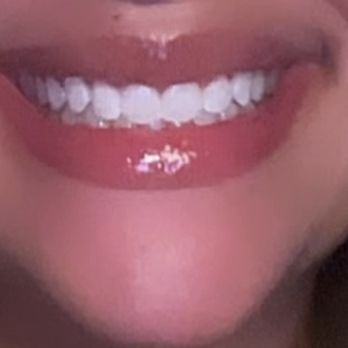 Luminux Professional Teeth Whitening - Teeth Whitening Near Me Luminux Professional Teeth Whitening - Teeth Whitening Near Me