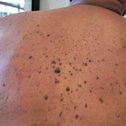 Back Skin Tag Growth Removal in Los Angeles Marina Del Rey Area.