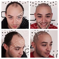 Scalp Aesthetics of Boca - Before and after pictures