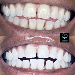 Pearled Teeth Whitening - Low Intensity Whitening with a 20 Minute Session. Instant Results and pain free.