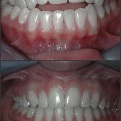 Russell Orthodontics - Before and After orthodontic treatment with Dr. Russell  (2 years)
