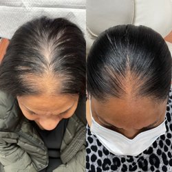 Hair Restoration and Aesthetics