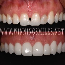WinningSmiles Custom Dentistry & Implant Center - The patient is congenitally missing one of the canine. Porcelain crowns and veneers were used to get this beautiful smile.