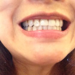 Baldwin Hoo, DDS - All white, shiny & smooth! Thank you Dr Hoo!