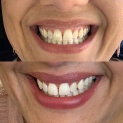 The Smile Center of Rochester - After 1 cleaning visit. They use water with baking soda to remove stains.