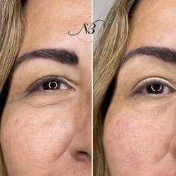 Nubella Med Spa - Juvaderm Ultra Plus injected under the eyes and mid face
