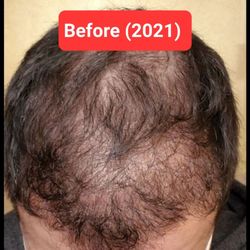 La Mesa Medical Hair Restoration