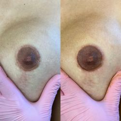 Areola correction pigmen