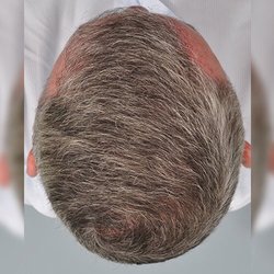 Ultimate Mens Hair Replacement - After !