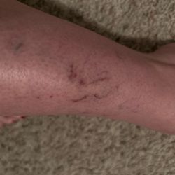 Paz Dermatology - Damaged veins caused at Paz Dermatology