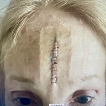 Biscayne Dermatology - Dr.Shagalov MOHs Surgery -SCAR Middle of Face - Dermatologists Near Me - Miami, Florida Biscayne Dermatology - Dr.Shagalov MOHs Surgery -SCAR Middle of Face - Dermatologists Near Me - Miami, Florida