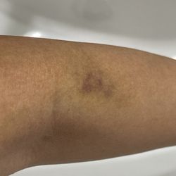 Quest Diagnostics - This bruise is 9 days after!