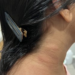 Skin rashes because the Brazilian Blowout cream was left in my hair for 2-3 days