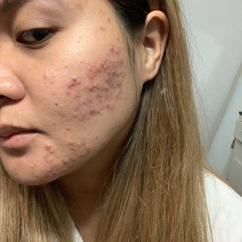 Acne Solutions Skin Care & Spa - Acne Treatment Near Me - Upland, California