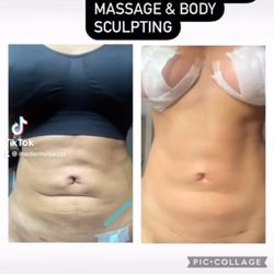 Results- Post Op Lymphatic with Body Sculpting