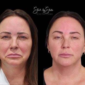 Stuck By Sticka - Full face rejuvenation with Botox and Juvederm Filler - Medical Spas Near Me - Keller, Texas Stuck By Sticka - Full face rejuvenation with Botox and Juvederm Filler - Medical Spas Near Me - Keller, Texas