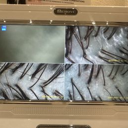 Before (bottom) and after (top right) of my scalp Before (bottom) and after (top right) of my scalp